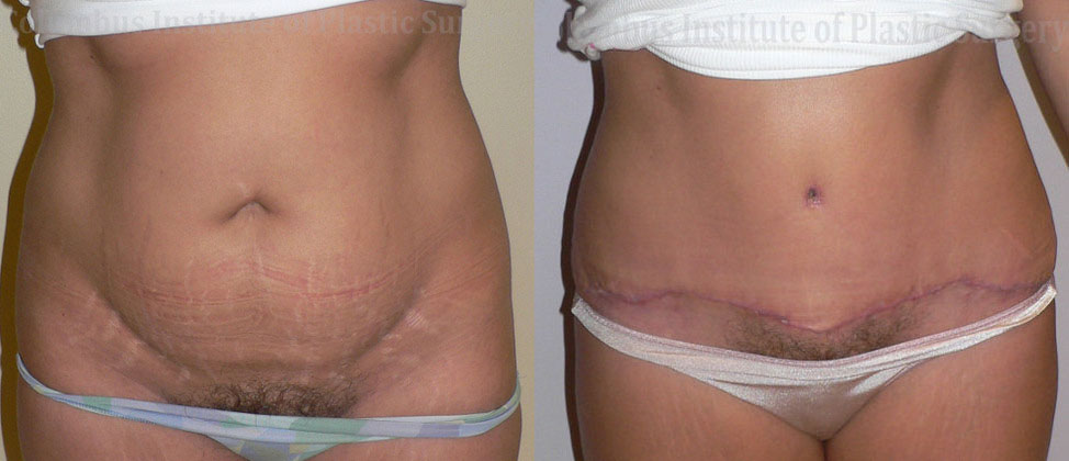 Abdominoplasty (Tummy Tuck) before and after photo by Columbus Institute of Plastic Surgery in Columbus, OH