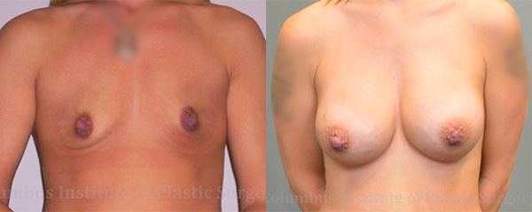 Breast Augmentation – 400cc-500cc before and after photo by Columbus Institute of Plastic Surgery in Columbus, OH