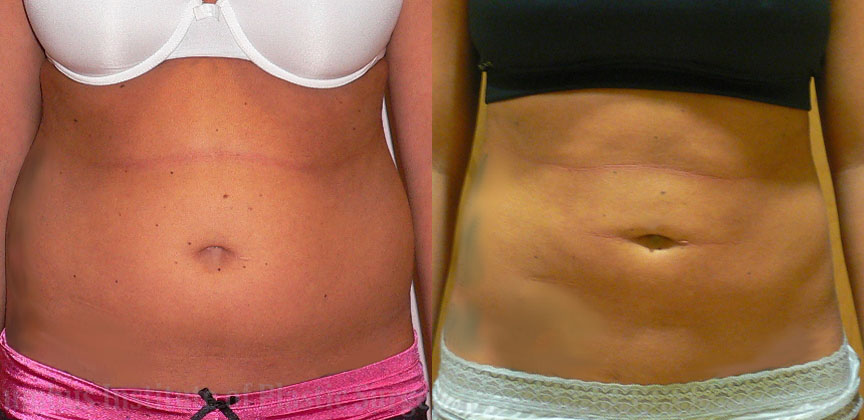 Liposuction before and after photo by Columbus Institute of Plastic Surgery in Columbus, OH