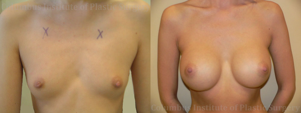 Breast Augmentation – 300cc-400cc before and after photo by Columbus Institute of Plastic Surgery in Columbus, OH