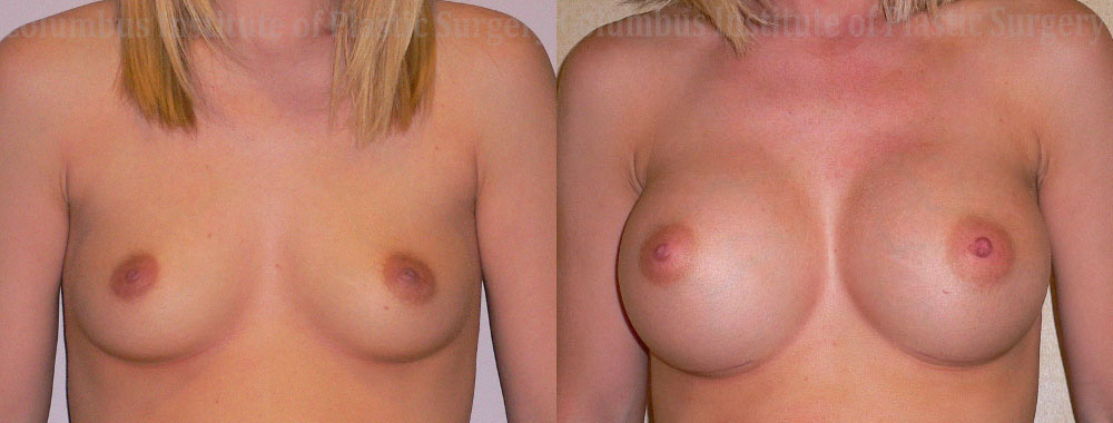 Breast Augmentation before and after photo by Columbus Institute of Plastic Surgery in Columbus, OH
