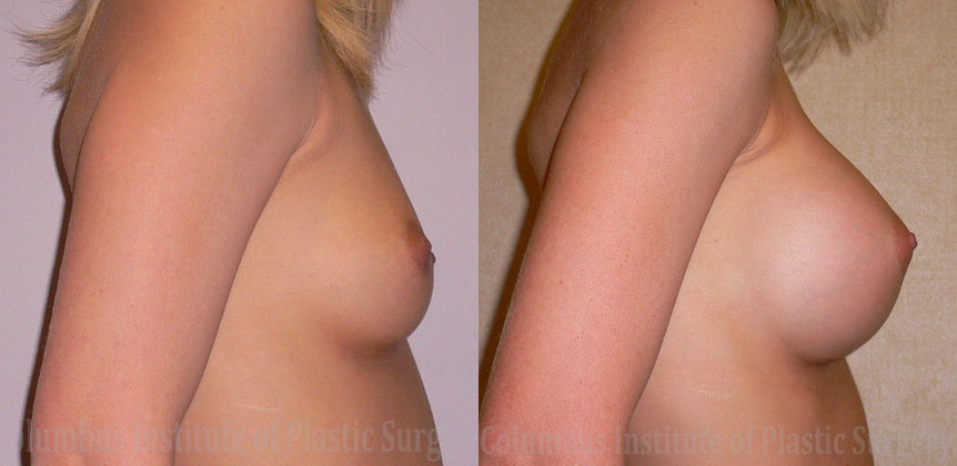 Breast Augmentation before and after photo by Columbus Institute of Plastic Surgery in Columbus, OH Breast Augmentation before and after photo by Columbus Institute of Plastic Surgery in Columbus, OH