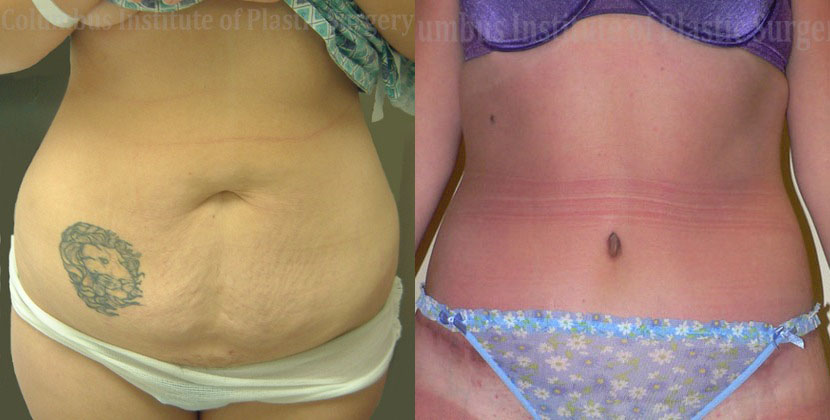 Abdominoplasty (Tummy Tuck) before and after photo by Columbus Institute of Plastic Surgery in Columbus, OH