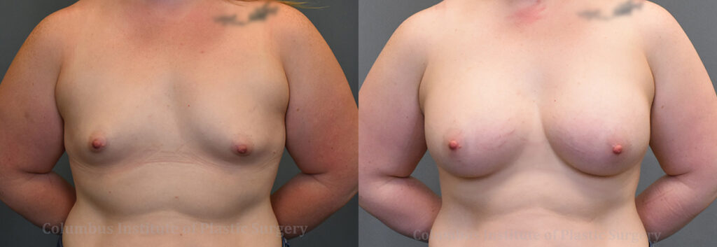 Breast Augmentation before and after photo by Columbus Institute of Plastic Surgery in Columbus, OH