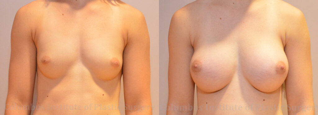 Breast Augmentation – 400cc-500cc before and after photo by Columbus Institute of Plastic Surgery in Columbus, OH