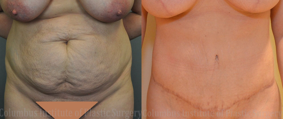 Liposuction before and after photo by Columbus Institute of Plastic Surgery in Columbus, OH