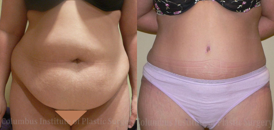 Abdominoplasty (Tummy Tuck) before and after photo by Columbus Institute of Plastic Surgery in Columbus, OH