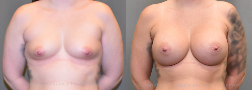 Breast Augmentation – 400cc-500cc before and after photo by Columbus Institute of Plastic Surgery in Columbus, OH