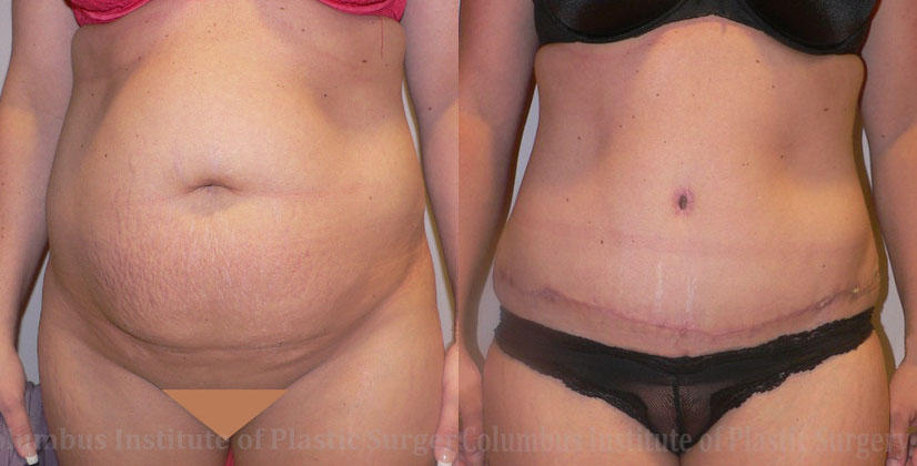 Abdominoplasty (Tummy Tuck) before and after photo by Columbus Institute of Plastic Surgery in Columbus, OH