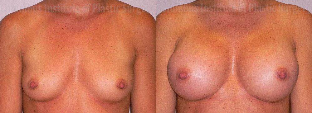 Breast Augmentation before and after photo by Columbus Institute of Plastic Surgery in Columbus, OH