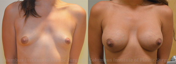 Breast Augmentation – 400cc-500cc before and after photo by Columbus Institute of Plastic Surgery in Columbus, OH