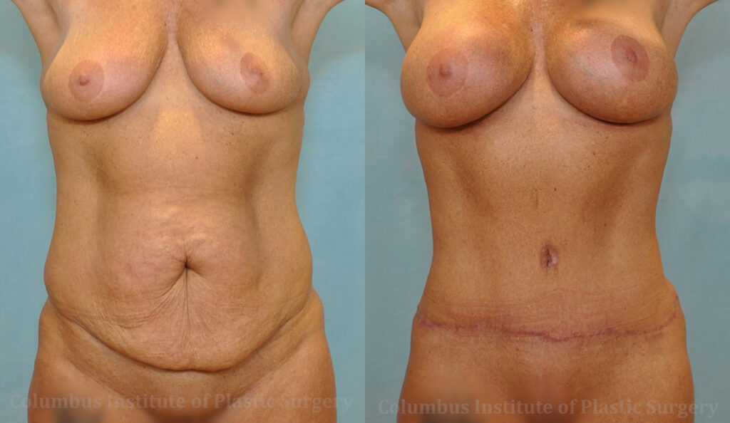 Abdominoplasty (Tummy Tuck) before and after photo by Columbus Institute of Plastic Surgery in Columbus, OH