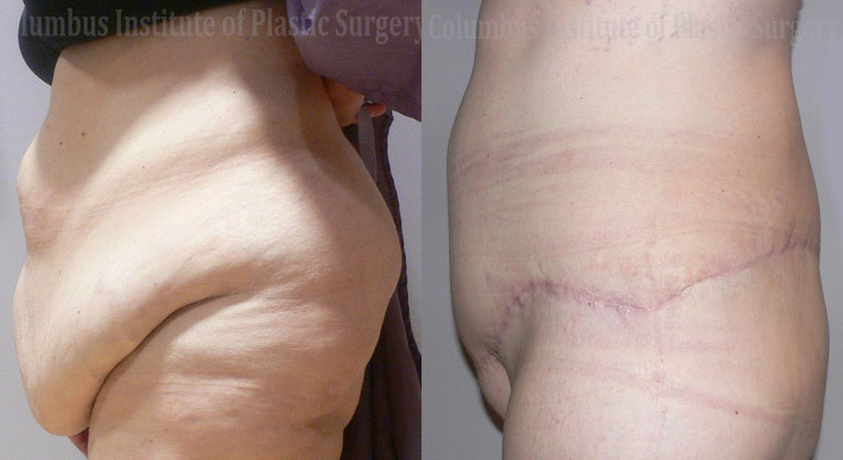 Belt Lipectomy before and after photo by Columbus Institute of Plastic Surgery in Columbus, OH