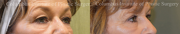 Blepharoplasty before and after photo by Columbus Institute of Plastic Surgery in Columbus, OH