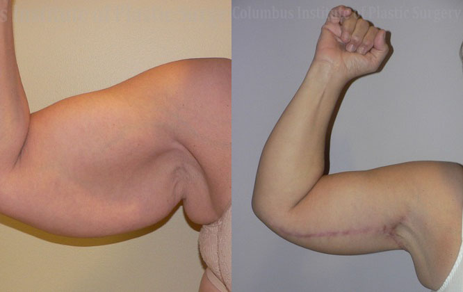 Brachioplasty (Arm Lift) before and after photo by Columbus Institute of Plastic Surgery in Columbus, OH