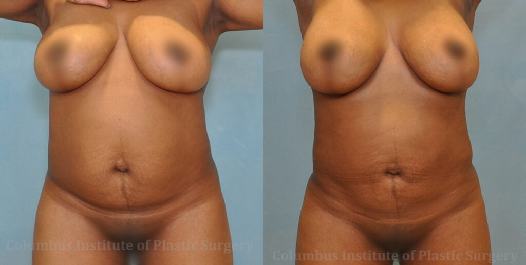 Liposuction before and after photo by Columbus Institute of Plastic Surgery in Columbus, OH