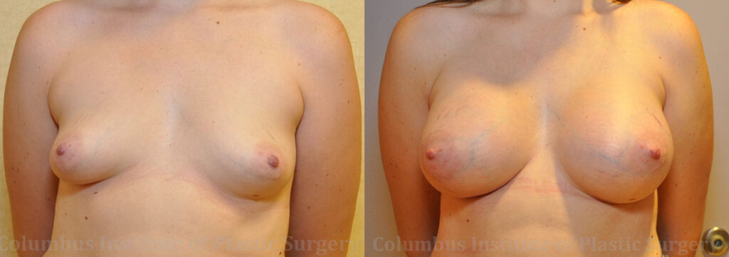 Breast Augmentation – 400cc-500cc before and after photo by Columbus Institute of Plastic Surgery in Columbus, OH