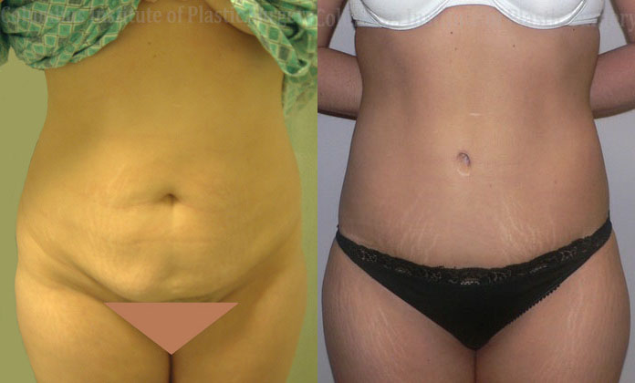 Abdominoplasty (Tummy Tuck) before and after photo by Columbus Institute of Plastic Surgery in Columbus, OH