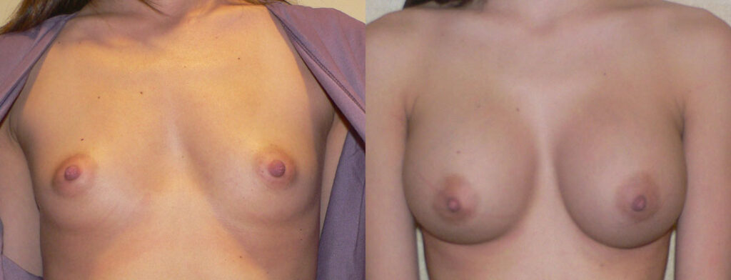 Breast Augmentation – 300cc-400cc before and after photo by Columbus Institute of Plastic Surgery in Columbus, OH