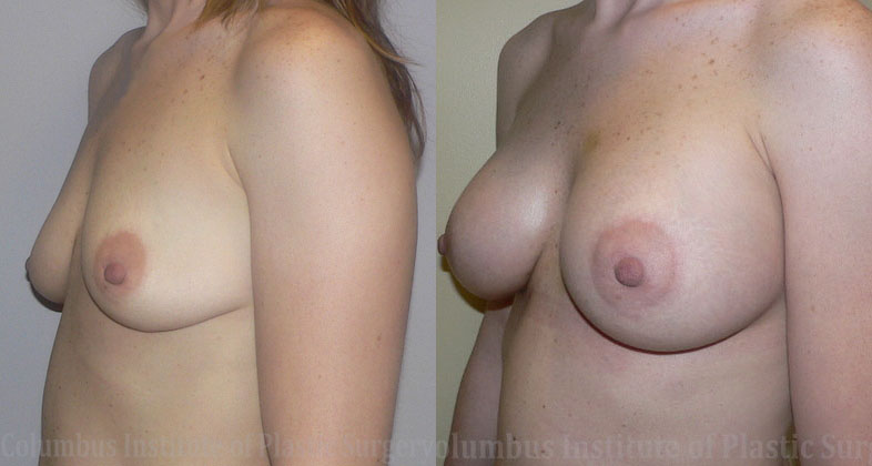 Breast Augmentation – 300cc-400cc before and after photo by Columbus Institute of Plastic Surgery in Columbus, OH