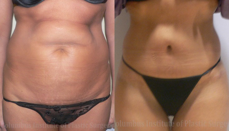 Abdominoplasty (Tummy Tuck) before and after photo by Columbus Institute of Plastic Surgery in Columbus, OH