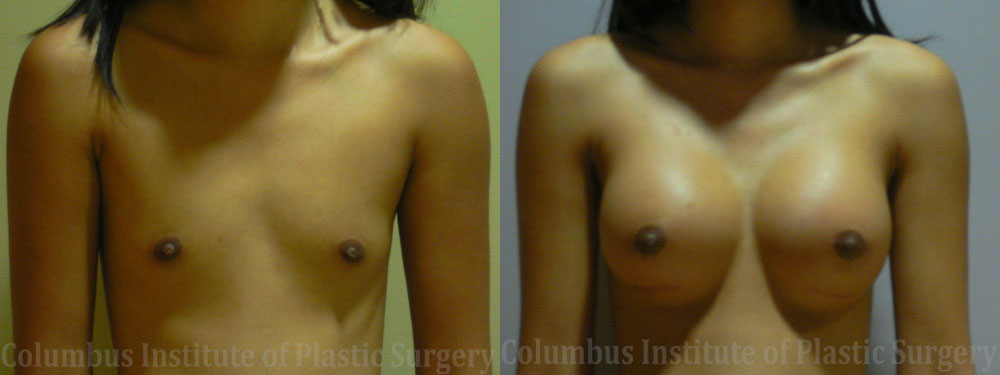 Breast Augmentation – 300cc-400cc before and after photo by Columbus Institute of Plastic Surgery in Columbus, OH