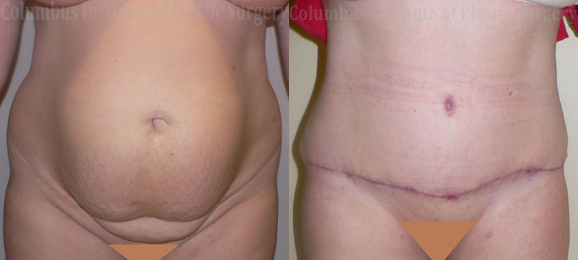 Abdominoplasty (Tummy Tuck) before and after photo by Columbus Institute of Plastic Surgery in Columbus, OH