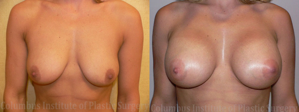 Breast Augmentation – 300cc-400cc before and after photo by Columbus Institute of Plastic Surgery in Columbus, OH