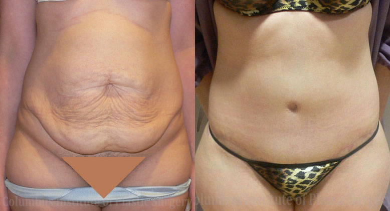 Abdominoplasty (Tummy Tuck) before and after photo by Columbus Institute of Plastic Surgery in Columbus, OH
