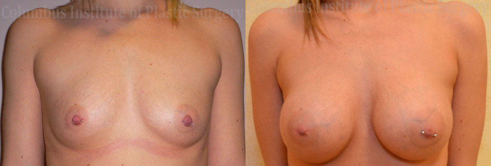 Breast Augmentation – 300cc-400cc before and after photo by Columbus Institute of Plastic Surgery in Columbus, OH