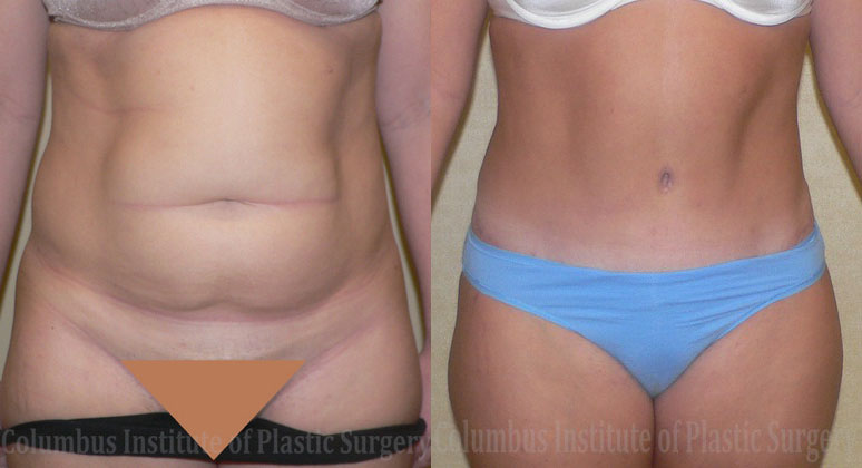 Abdominoplasty (Tummy Tuck) before and after photo by Columbus Institute of Plastic Surgery in Columbus, OH