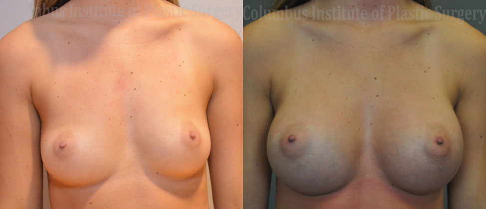 Breast Augmentation – 300cc-400cc before and after photo by Columbus Institute of Plastic Surgery in Columbus, OH