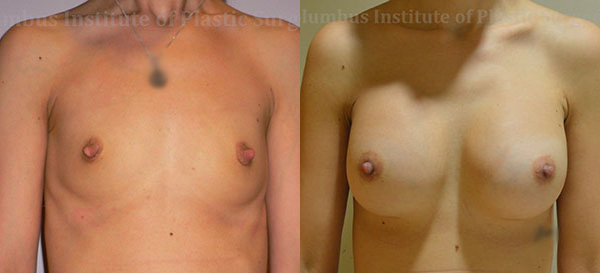 Breast Augmentation – 400cc-500cc before and after photo by Columbus Institute of Plastic Surgery in Columbus, OH