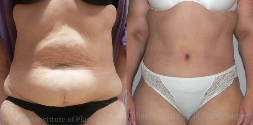 Abdominoplasty (Tummy Tuck) before and after photo by Columbus Institute of Plastic Surgery in Columbus, OH