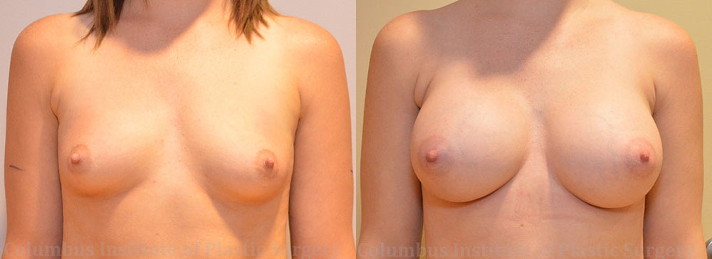 Breast Augmentation – 400cc-500cc before and after photo by Columbus Institute of Plastic Surgery in Columbus, OH