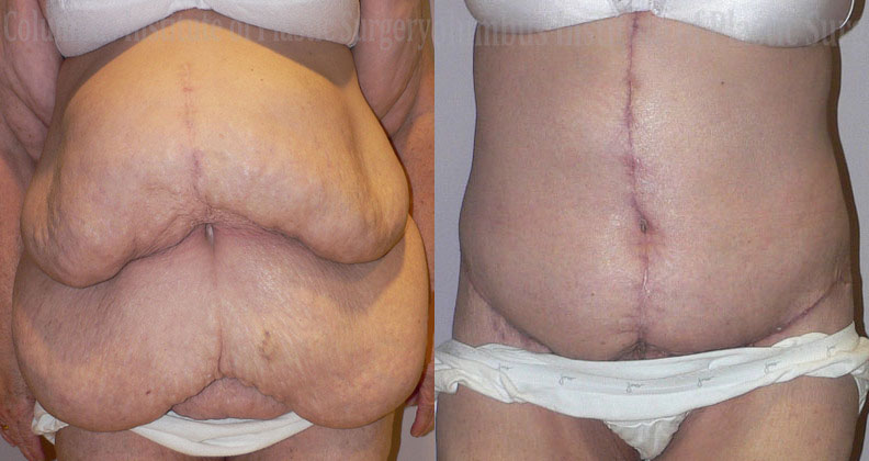 Belt Lipectomy before and after photo by Columbus Institute of Plastic Surgery in Columbus, OH