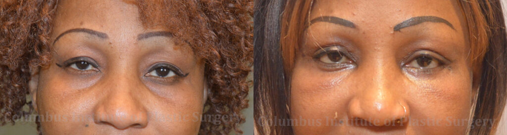 Blepharoplasty before and after photo by Columbus Institute of Plastic Surgery in Columbus, OH