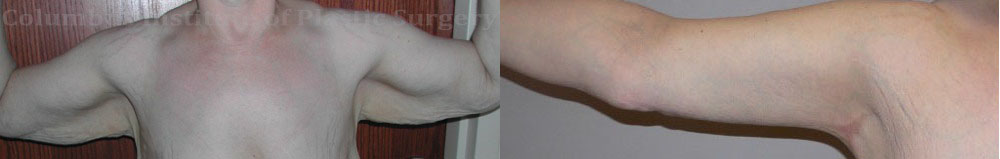 Brachioplasty (Arm Lift) before and after photo by Columbus Institute of Plastic Surgery in Columbus, OH