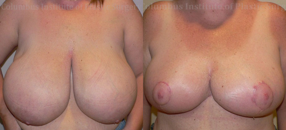 Breast Reduction before and after photo by Columbus Institute of Plastic Surgery in Columbus, OH