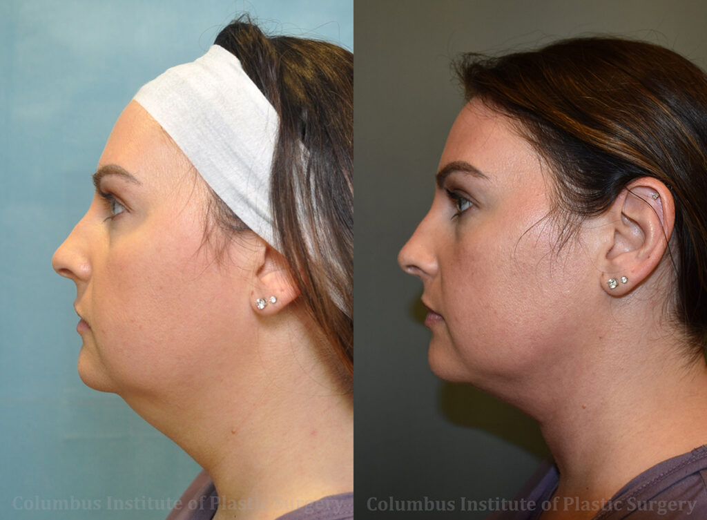 Liposuction before and after photo by Columbus Institute of Plastic Surgery in Columbus, OH