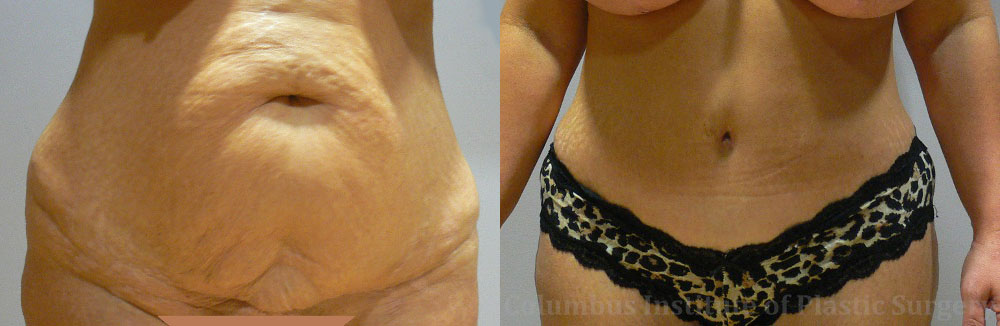 Abdominoplasty (Tummy Tuck) before and after photo by Columbus Institute of Plastic Surgery in Columbus, OH