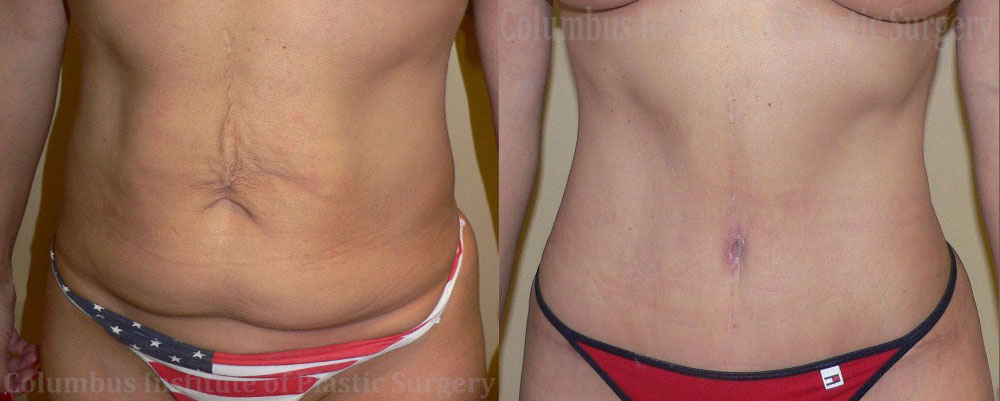 Abdominoplasty (Tummy Tuck) before and after photo by Columbus Institute of Plastic Surgery in Columbus, OH