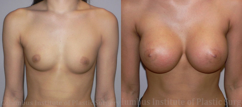 Breast Augmentation before and after photo by Columbus Institute of Plastic Surgery in Columbus, OH