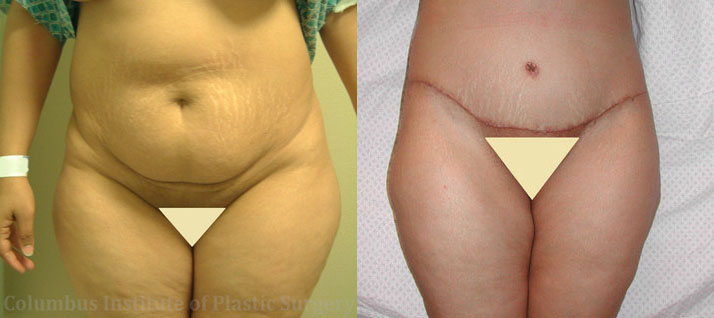 Abdominoplasty (Tummy Tuck) before and after photo by Columbus Institute of Plastic Surgery in Columbus, OH