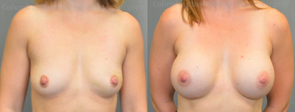 Breast Augmentation – 400cc-500cc before and after photo by Columbus Institute of Plastic Surgery in Columbus, OH