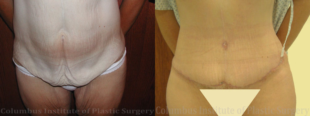 Abdominoplasty (Tummy Tuck) before and after photo by Columbus Institute of Plastic Surgery in Columbus, OH