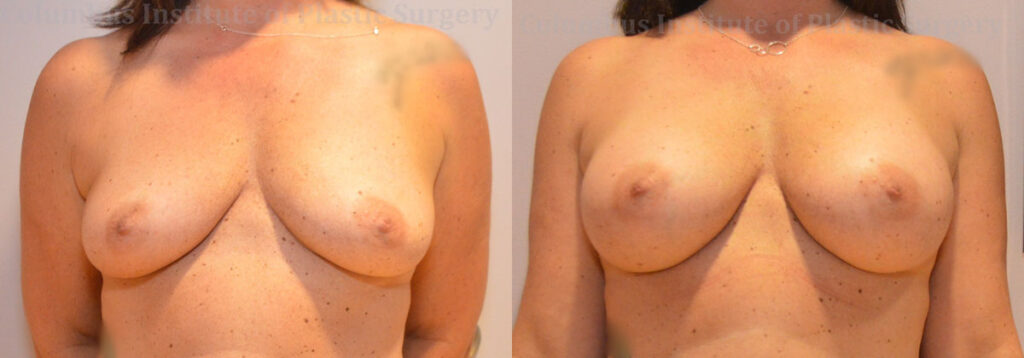 Breast Augmentation – 400cc-500cc before and after photo by Columbus Institute of Plastic Surgery in Columbus, OH