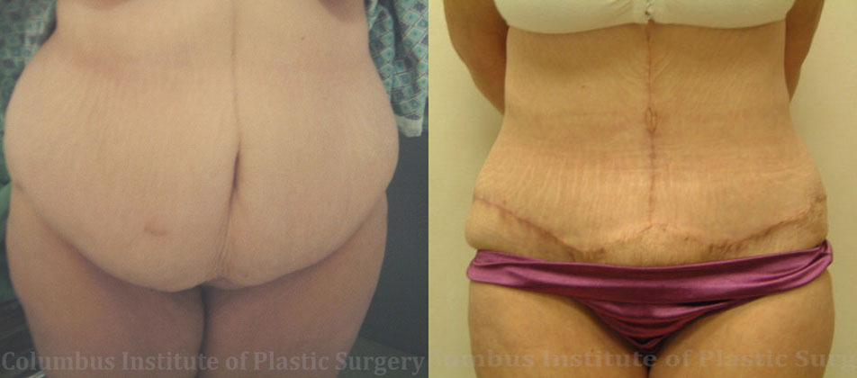 Abdominoplasty (Tummy Tuck) before and after photo by Columbus Institute of Plastic Surgery in Columbus, OH
