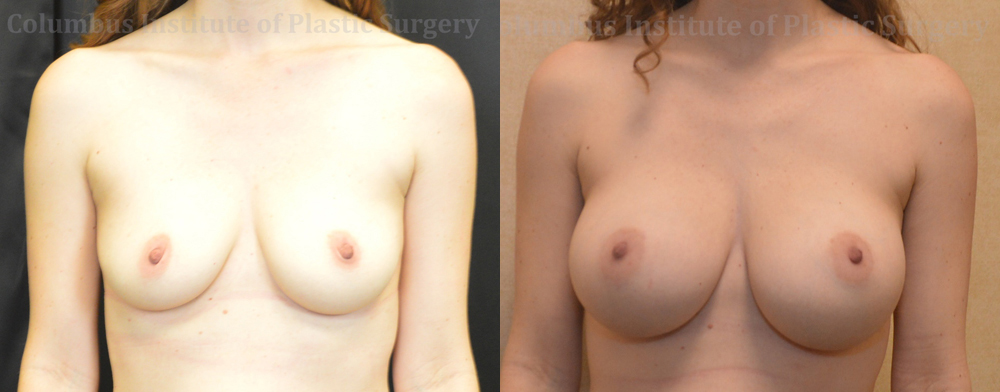 Breast Augmentation – 400cc-500cc before and after photo by Columbus Institute of Plastic Surgery in Columbus, OH