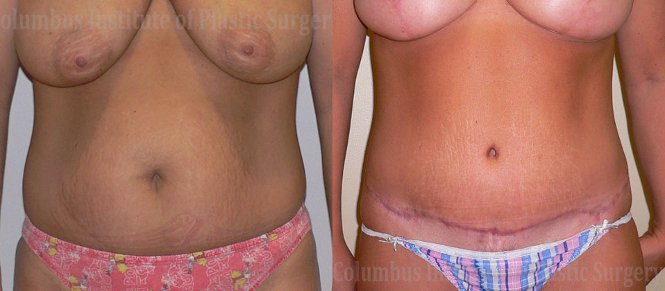 Abdominoplasty (Tummy Tuck) before and after photo by Columbus Institute of Plastic Surgery in Columbus, OH